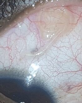 NEOflorax ha aiutato a sbarazzarsi di un verme negli occhi